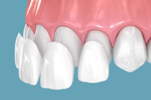 Dental Veneers Hobbs