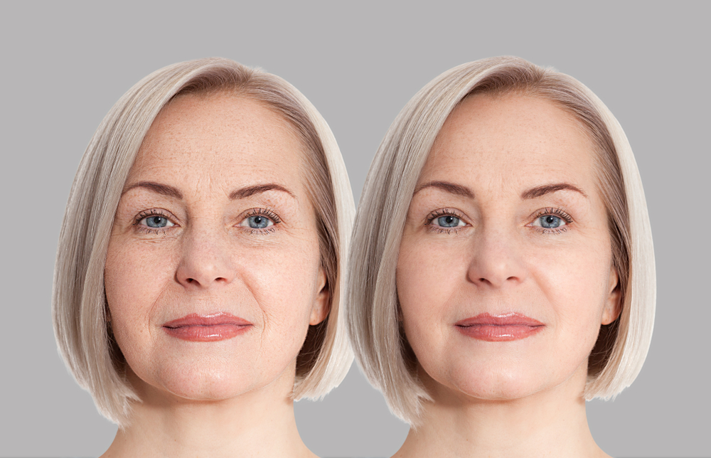 beautiful transformation after Botox at CloudView Dental
