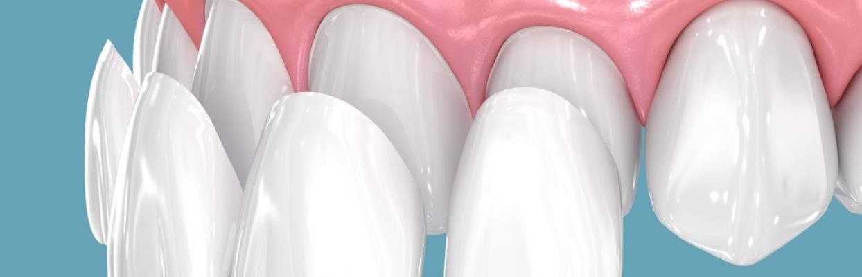 Dental Veneers in Hobbs: Get a Smile That Reflects You